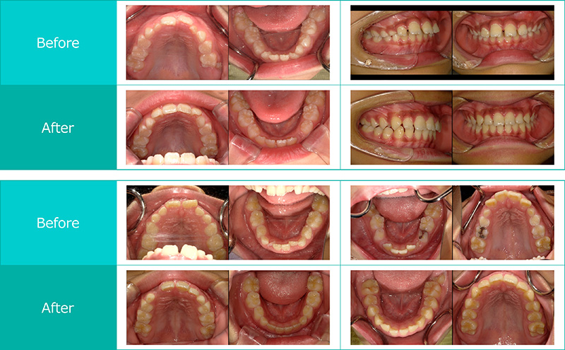 施術前と施術後の比較口内写真