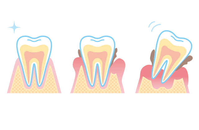 歯周病治療イメージ